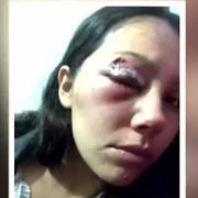 Más de 100 personas han perdido la visión por impacto con balines, denunció el Colegio Médico