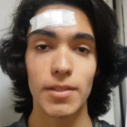 Joven de 17 años recibe impacto de balín en su frente, lanzado por efectivos militares