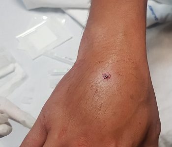 Tres días hospitalizado deberá estar el reportero gráfico que sufrió fractura expuesta grave en su mano, por impacto de proyectil de plomo lanzado por militares