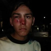 Con tres fracturas en su rostro resultó adolescente que recibió impacto de bomba lacrimógena lanzada por FFEE de Carabineros