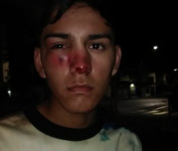 Con tres fracturas en su rostro resultó adolescente que recibió impacto de bomba lacrimógena lanzada por FFEE de Carabineros