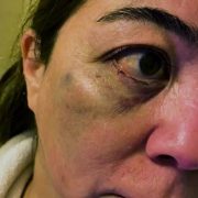 Periodista de Linderos víctima de brutal golpiza de Carabineros, luego de pedir que corrigieran redacción de denuncia que presentó